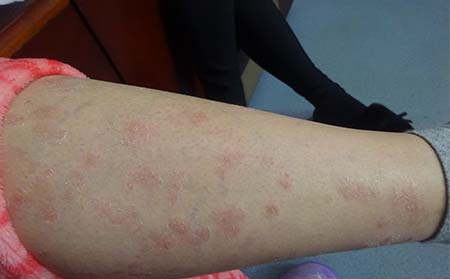 牛皮癣病因,为什么会得牛皮癣