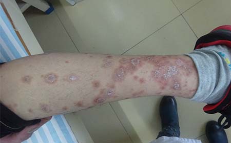 牛皮癣病因,什么原因造成牛皮癣