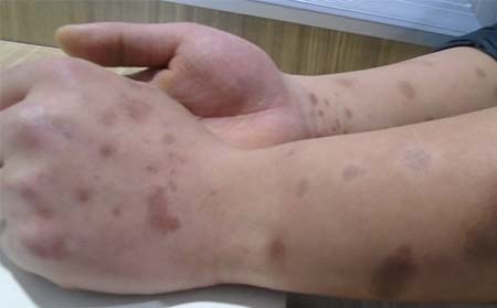 寻常型银屑病症状,寻常型银屑病好转症状