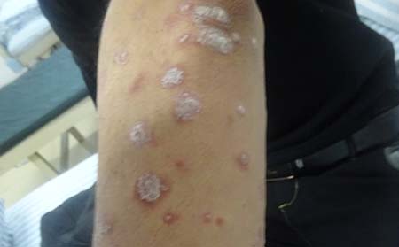 寻常型银屑病病因,寻常型银屑病发病原因