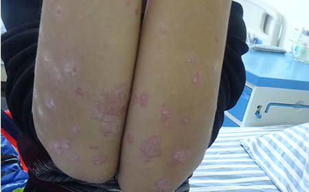 女性牛皮癣症状,女性有牛皮癣表现