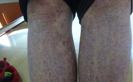 潍坊银屑病,银屑病有什么症状