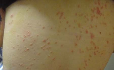 儿童牛皮癣症状,儿童牛皮癣初期症状