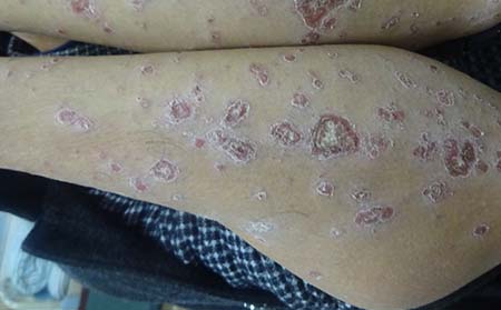 银屑病早期症状,银屑病症状护理