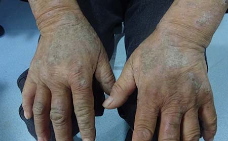 关节型银屑病症状,银屑病关节炎症状