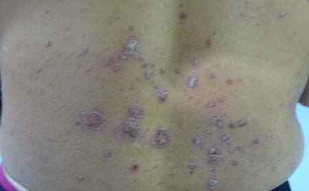 银屑病症状,银屑病早期症状