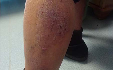 银屑病发病原因,为什么长银屑病