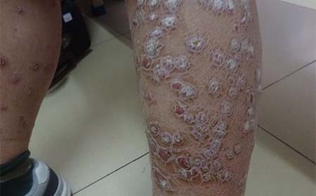 腿部银屑病病因,腿部为什么长银屑病
