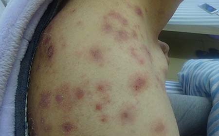 女性牛皮癣常识,女性得牛皮癣常识