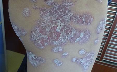 早期牛皮癣病因,早期牛皮癣发病原因