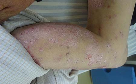 银屑病发病原因,为什么银屑病发病