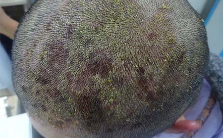 头部银屑病治疗,怎样治头部银屑病