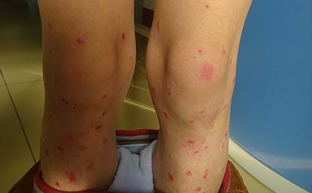 女性银屑病症状,女性得银屑病症状