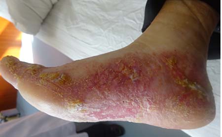 脚部银屑病病因,脚上银屑病病因