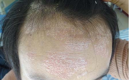 银屑病症状表现,得银屑病什么症状