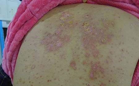 遗传性银屑病症状,银屑病症状表现