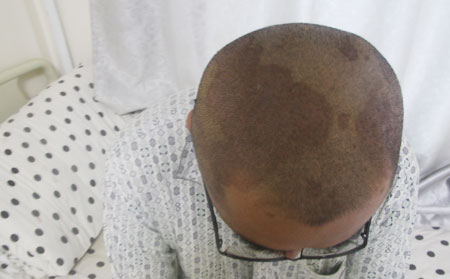 头部牛皮癣症状,头部牛皮癣症状特点