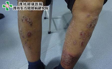 顽固银屑病治疗,怎样治顽固银屑病