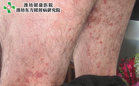 潍坊银康医院：治疗银屑癣的快速的药物