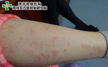 银屑病怎样治,皮肤银屑病怎样治疗