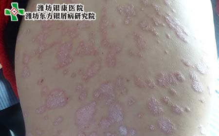 银屑病症状,银屑病典型症状