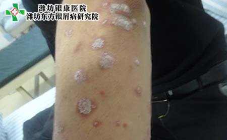 银屑病症状,银屑病临床症状表现