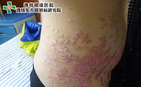 银屑病症状,得银屑病有什么症状