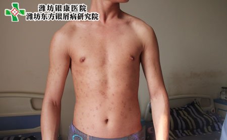 牛皮癣如何预防,男性牛皮癣怎样预防