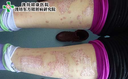 牛皮癣症状,怎样诊断牛皮癣症状