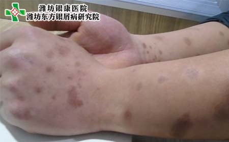银屑病防治,怎样防治银屑病