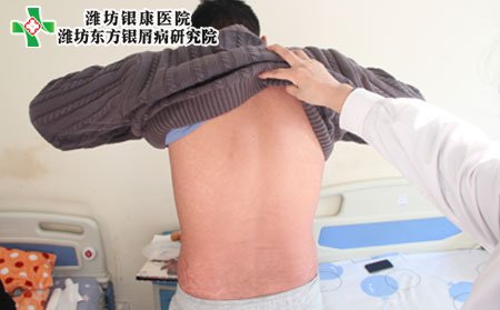 潍坊牛皮癣医院为您介绍牛皮癣危害及图片