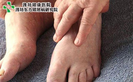 潍坊银屑病医院教您如何通过脚部观测银屑病